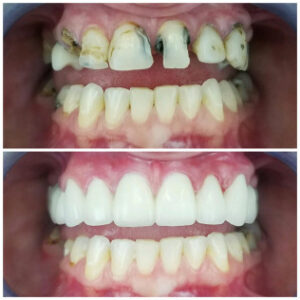 Patient Spotlight before and after - affordable dentist in duncanville