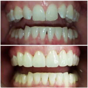 Patient Spotlight before and after - affordable dentist in duncanville
