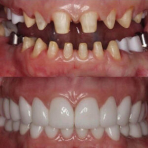 Before After Smile Image