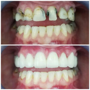 Before After Smile Image