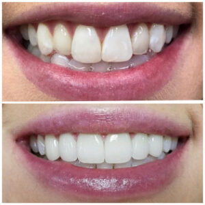 Before After Smile Image