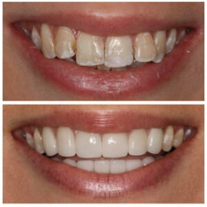 Before After Smile Image