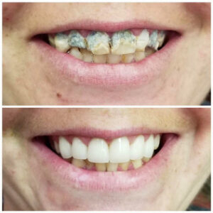 Before After Smile Image