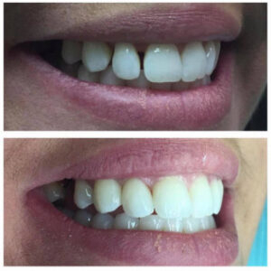 Before After Smile Image