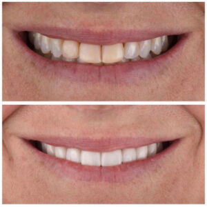 Before After Smile Image