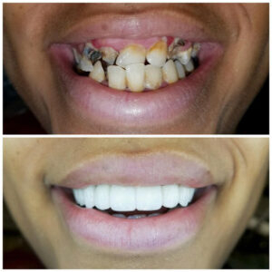 Before After Smile Image