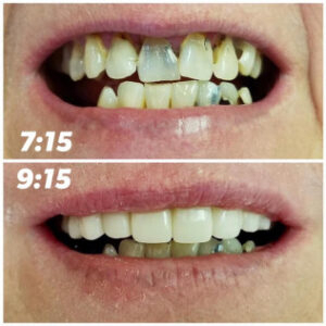 Before After Smile Image