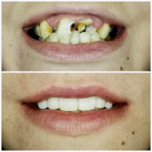 Before After Smile Image