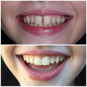 Before After Smile Image