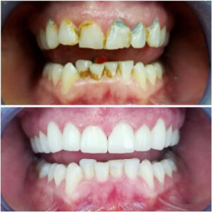 Before After Smile Image