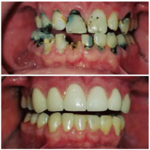 Before After Smile Image