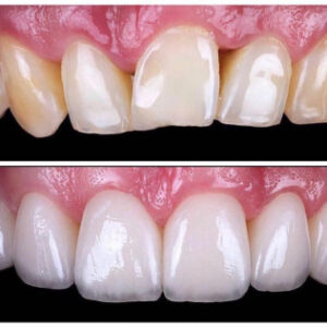 Before After Smile Image