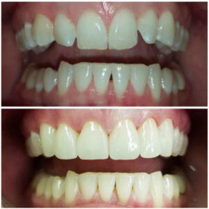 Before After Smile Image