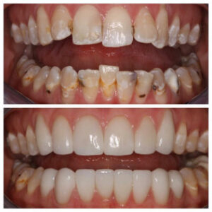 Before After Smile Image