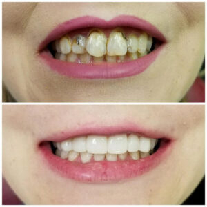 Before After Smile Image