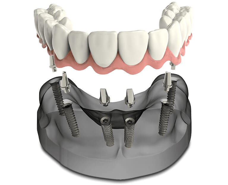 Benefits of Teeth-In-A-Day Implants