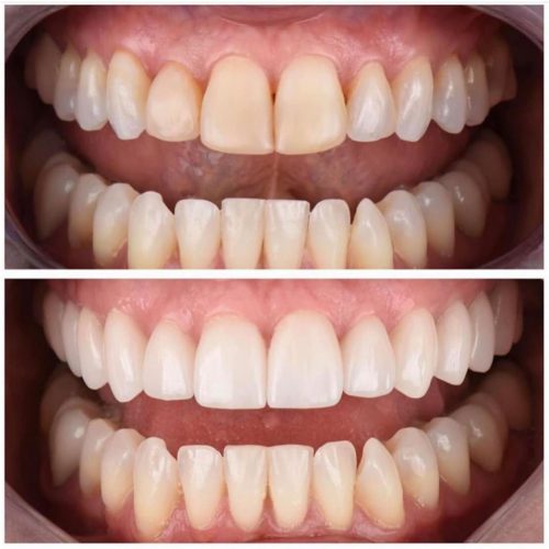 Smile Makeover before & after